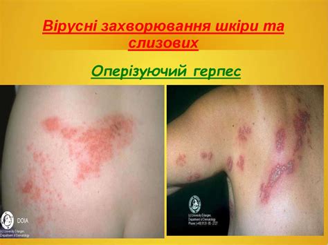 Піодермії. Дерматомікози. Дерматозоонози. Вірусні дерматози ...