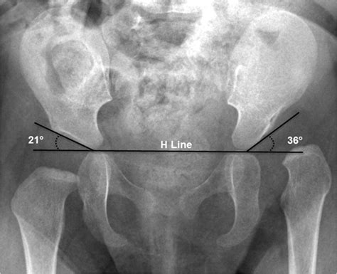 Congenital Hip Dysplasia Xray