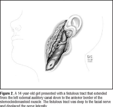 Figure 1 From Anatomical Variations Of The Facial Nerve In First