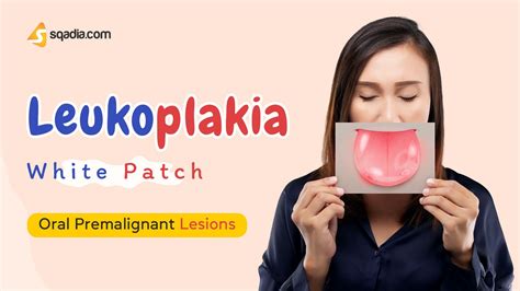 Leukoplakia