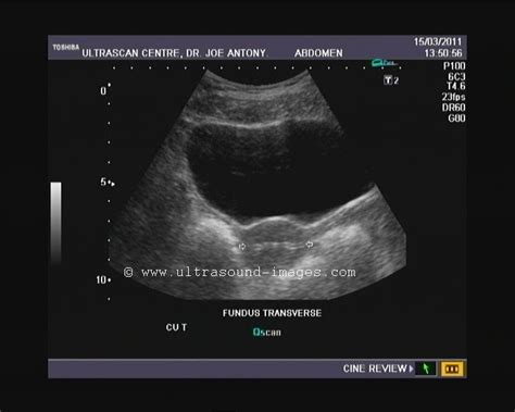 Ultrasound And Color Doppler Videos Copper T Iucd