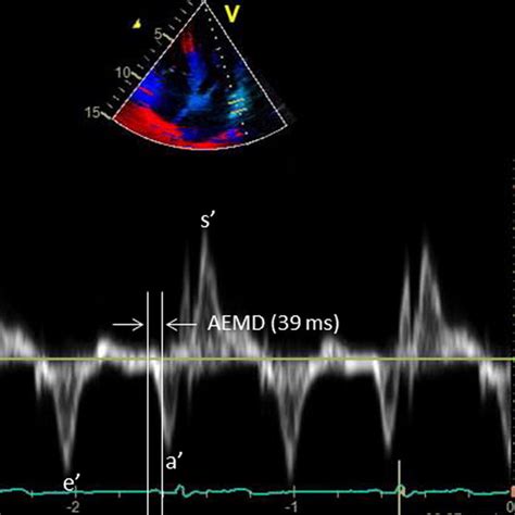 The Mitral Annular Velocity Profile By Tdi A And The Strain Curves