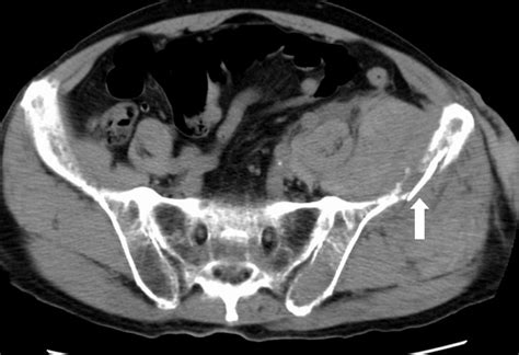 CT Scan Showing A Fracture Of The Left Ilium Arrow Which Caused A