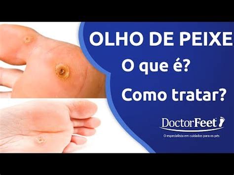 Olho De Peixe No Pé O Que Causa Sobre os Olhos