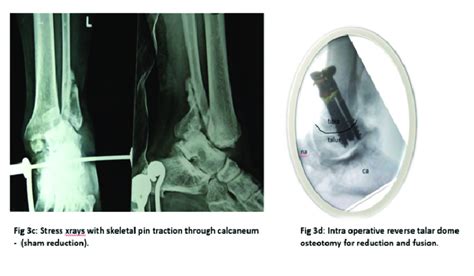 C Stress Xrays With Skeletal Pin Traction Through Calcaneum Sham