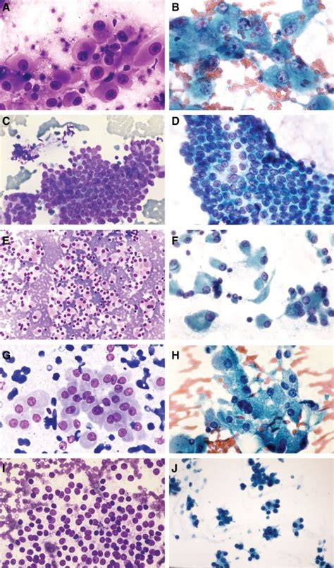 A And B Aspirates From Anaplastic Thyroid Carcinoma Show Large