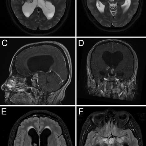 Axial T2 Weighted Magnetic Resonance Imaging Mri Sequences