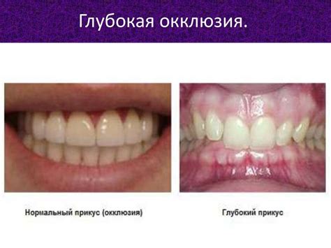 Формы глубокой окклюзии и дизокклюзии - презентация онлайн