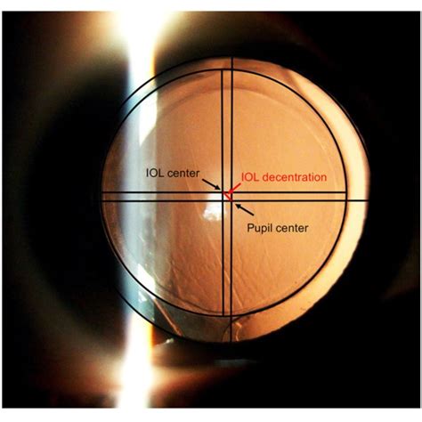 Post Operative Anterior Segment Photography With Dilated Pupil The Download Scientific