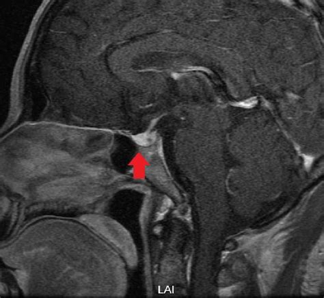 Pituitary Mri Enhancement Findings Sagittal Hypointense Nodules