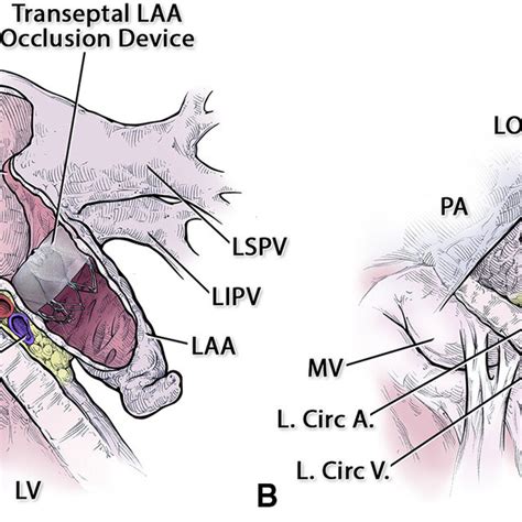 The Methods Of Left Atrial Appendage Laa Closure Share The Same