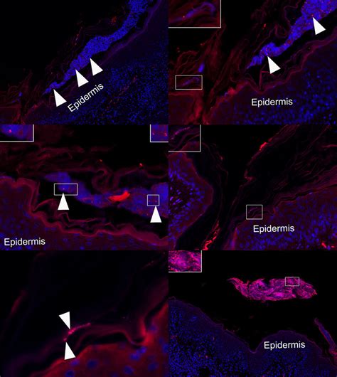 Fluorescence In Situ Hybridization Fish Of Paraffin Embedded Skin