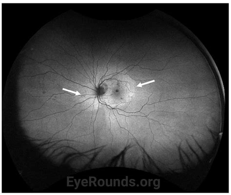 Acute Syphilitic Posterior Placoid Chorioretinitis