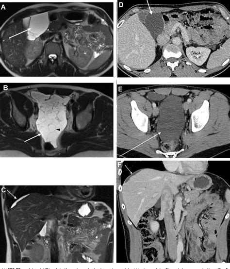 Intra Abdominal Benign Multicystic Peritoneal Mesothelioma Semantic