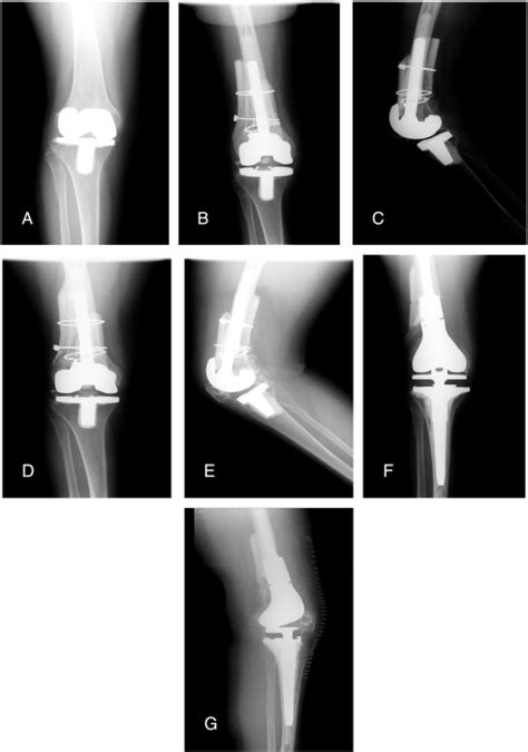 Intraoperative Fracture During Aseptic Revision Total Knee Arthroplasty The Journal Of