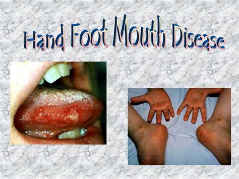 PPT - Hand Foot Mouth Disease PowerPoint Presentation, free download - ID:3543529