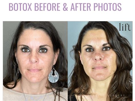 Botox Cosmetic Before After Photos Houston TX Med Spa Webster