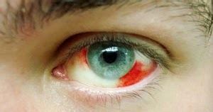 What causes a red spot on the eye?