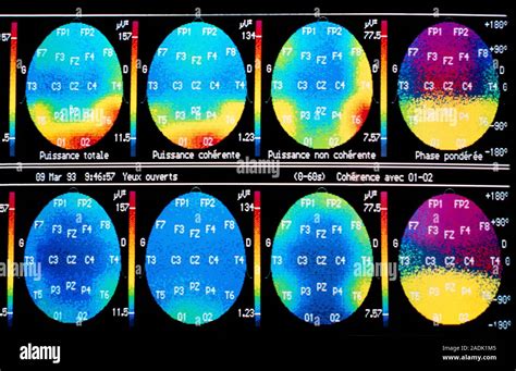 Normal alpha brain waves. Series of 8 coloured scans showing one person ...