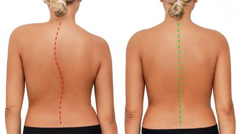 Scoliosis And Posture Tips For Maintaining A Healthy Spine Step Up