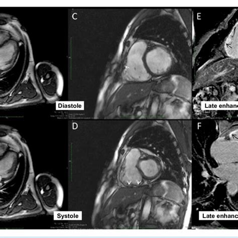 Cardiac Magnetic Resonance Imaging A To D Cine Mri According To The