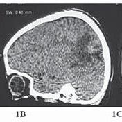 Preoperative Ct Scan Of Head Revealing A Small Ill Defi Ned Lesion In