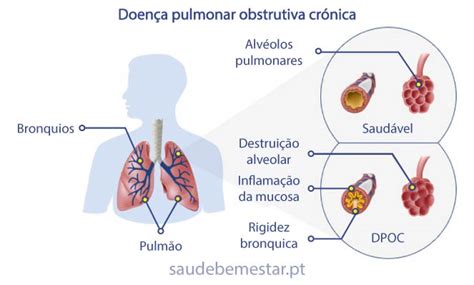 Fisiopatologia Da Dpoc Doenca Pulmonar Obstrutiva Cronica Nbkomputer