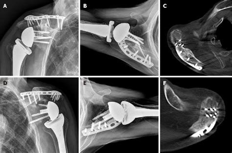 Figure From Simultaneous Bilateral Acromial Base Fractures After