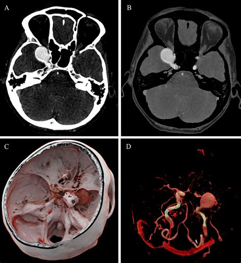 Cerebral Aneurysm Mri