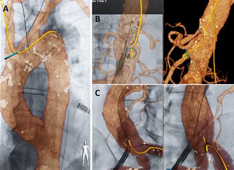 Fiber Optic Realshape Fors Imaging Using Upper Extremity And