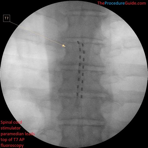 Fluoroscopic Guided Thoraciclumbar Medial Branch Radiofrequency