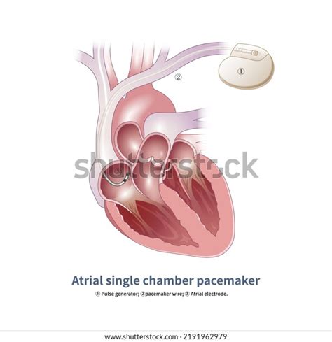 Atrial Single Chamber Pacemakers Have Only Stock Illustration