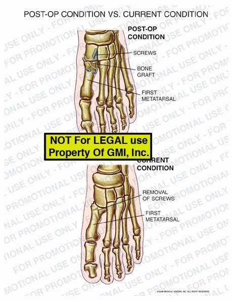 Post Op Condition Vs Current Condition 95195b Generic Medical Legal Exhibits A Division Of Mvi