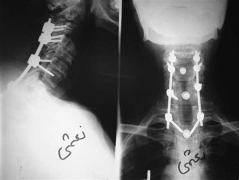 Intramedullary Arachnoid Cyst In Association With Cervical Spondylosis