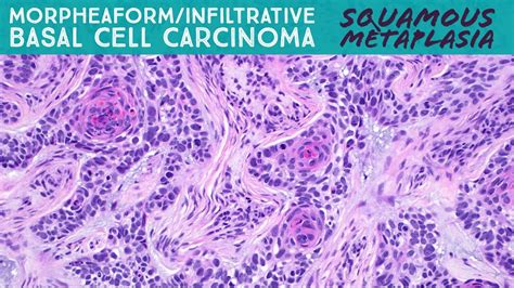 Basal Cell Carcinoma Histology