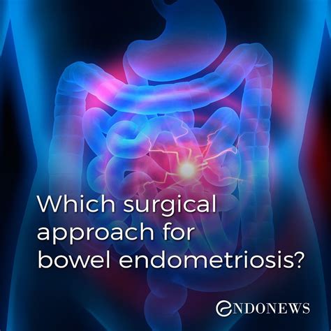 Laparoscopy Endometriosis, Endometriosis Surgery, Concordance, Bowels ...