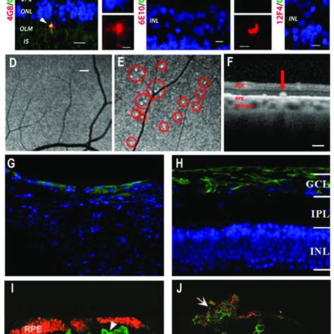 Amyloid β Aβ Accumulations In The Retina For Alzheimers Disease