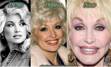 Dolly Parton Breast Implants – Before and After Pictures | Plastic