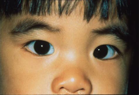 Strabismus Pathologies Flashcards Quizlet