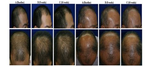 Potential Cure For Baldness As Stem Cells Found To Trigger Hair Growth