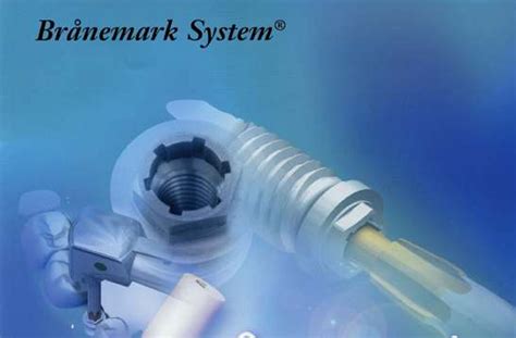 Nobel Biocare Branemark System Mk Iii Tiunite Implant Dentaire