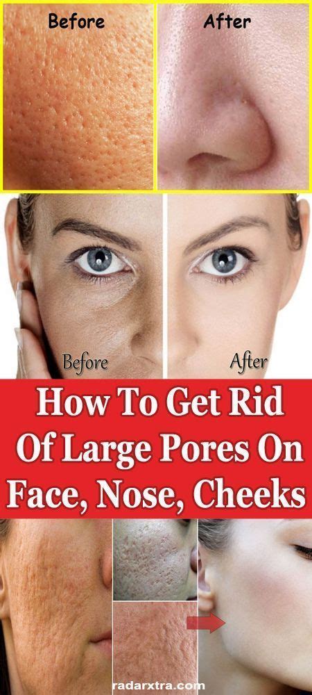 How To Get Rid Of Clogged Pores In 2020 With Images Nose Pores Get Rid Of Pores Face Pores