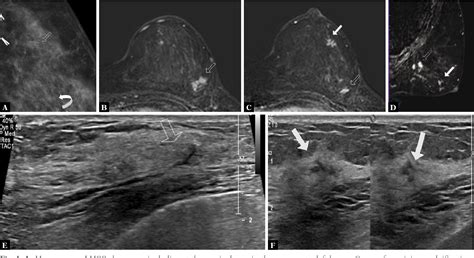 Figure From Ultrasound Guided Vacuum Assisted Breast Biopsy In The