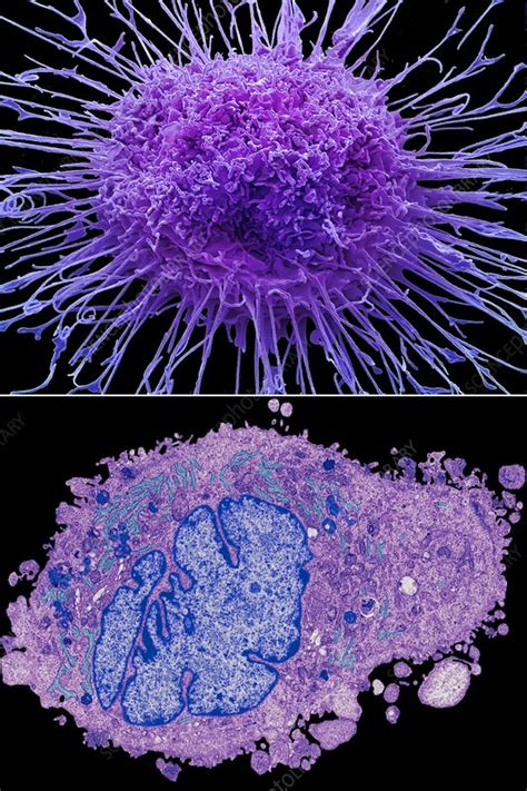 Lung Cancer SEM TEM Comparison Stock Image C047 7028 Science