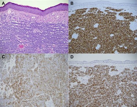 Merkel Cell Carcinoma Of The Eyelid A Review Survey Of Ophthalmology