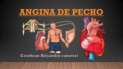 Angina De Pecho CRISTHIAN ALEJANDRO CANAVIRI HUARACHI SKETCH