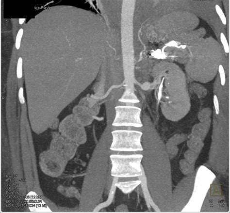 Left Renal Artery Aneurysm Vascular Case Studies Ctisus Ct Scanning