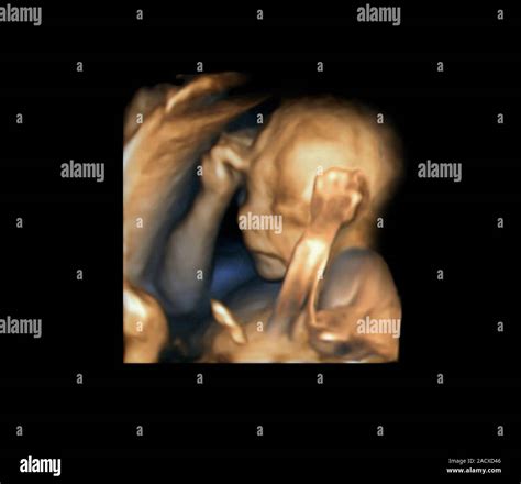 Healthy Foetus At Around The Th Week Of Development Coloured D