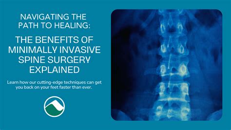 Minimally Invasive Spine Surgery Benefits Key Advantages To Spinal