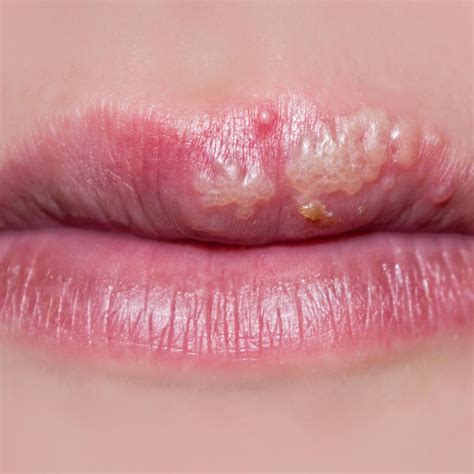 Herpes Zoster Gleich Lippenherpes Infoupdate Org